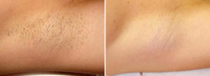 armpits2